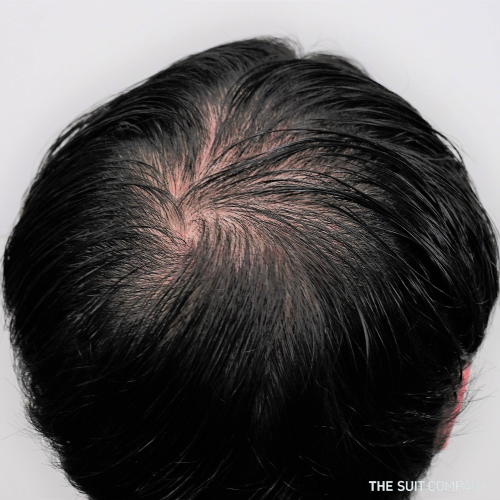 頭頂部はげの原因と対策を解説 はげの基準やおすすめの髪型とは Values